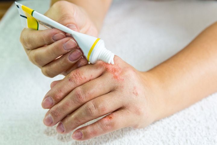 Nerwica skóry może objawiać się różnymi zmianami dermatologicznymi
