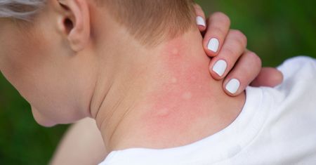 Jak pozbyć się swędzenia po ukąszeniach komarów? Domowe sposoby