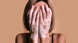 Hipopigmentacja (białe plamy na skórze) - rodzaje, przyczyny, diagnostyka, leczenie