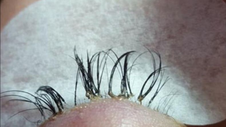 Przedłużanie rzęs skończyło się dla tej kobiety dramatycznie