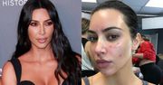 Kim Kardashian szczerze o walce z łuszczycą: "Ból był nie do zniesienia. Nie mogłam podnieść telefonu"