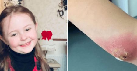 6-letnia dziewczynka przeszła operację po ugryzieniu pająka. Matka ostrzega rodziców przed owadami