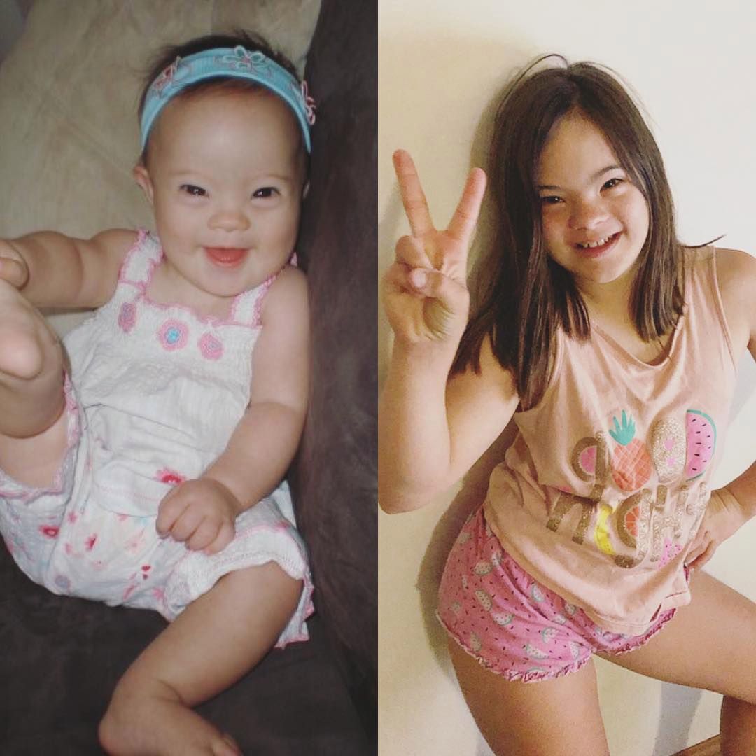 Lily urodziła się z zespołem Downa. Lekarz namawiał jej mamę do aborcji