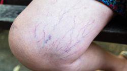 Pajączki na nogach to nie tylko problem estetyczny. Mogą ostrzegać o groźnym schorzeniu