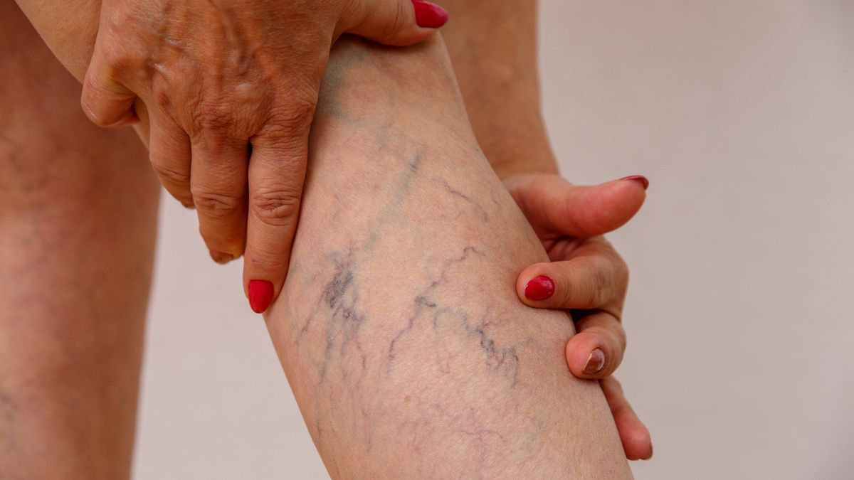 elderly woman shows varicosevaricose veins of eldelry woman.Azat_ajphotos