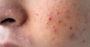 Trądzik pospolity - objawy, przyczyny, leczenie i pielęgnacja skóry