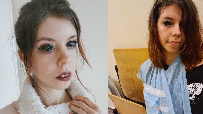 "Fanka Popka" z wytatuowanymi gałkami ocznymi zbiera pieniądze na leczenie