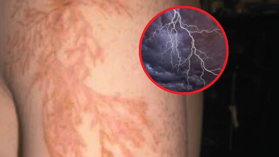 Porażenie piorunem może doprowadzić do zgonu