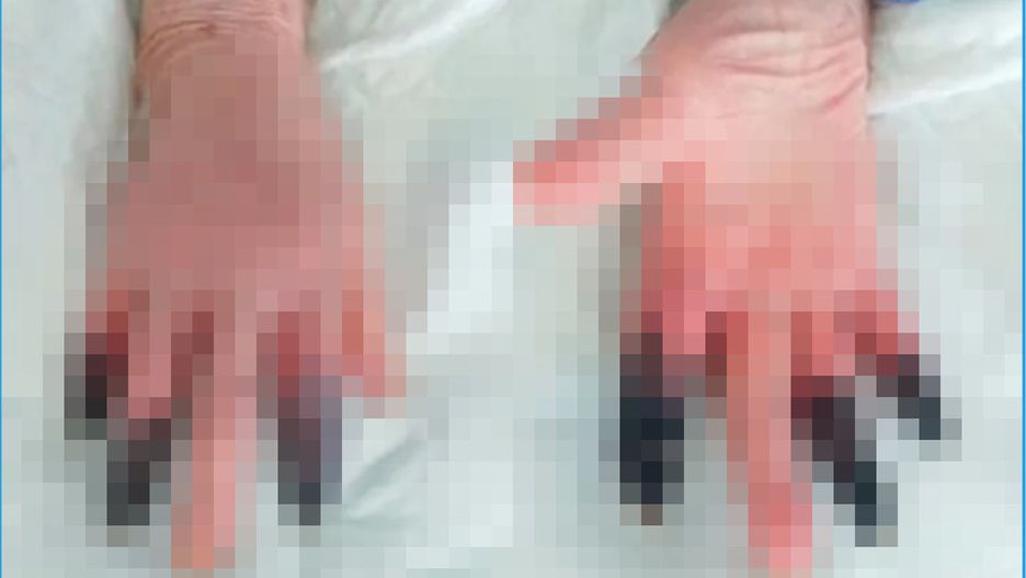 Dłonie przed amputacją palcy