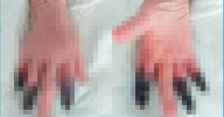 Musiała mieć amputowane palce. Koronawirus uszkadza naczynia krwionośne