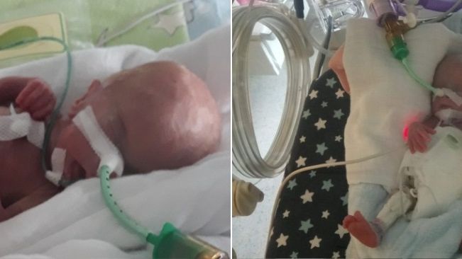 Michalina urodziła się ważąc 370 g. To druga najmniejsza dziewczynka w Polsce