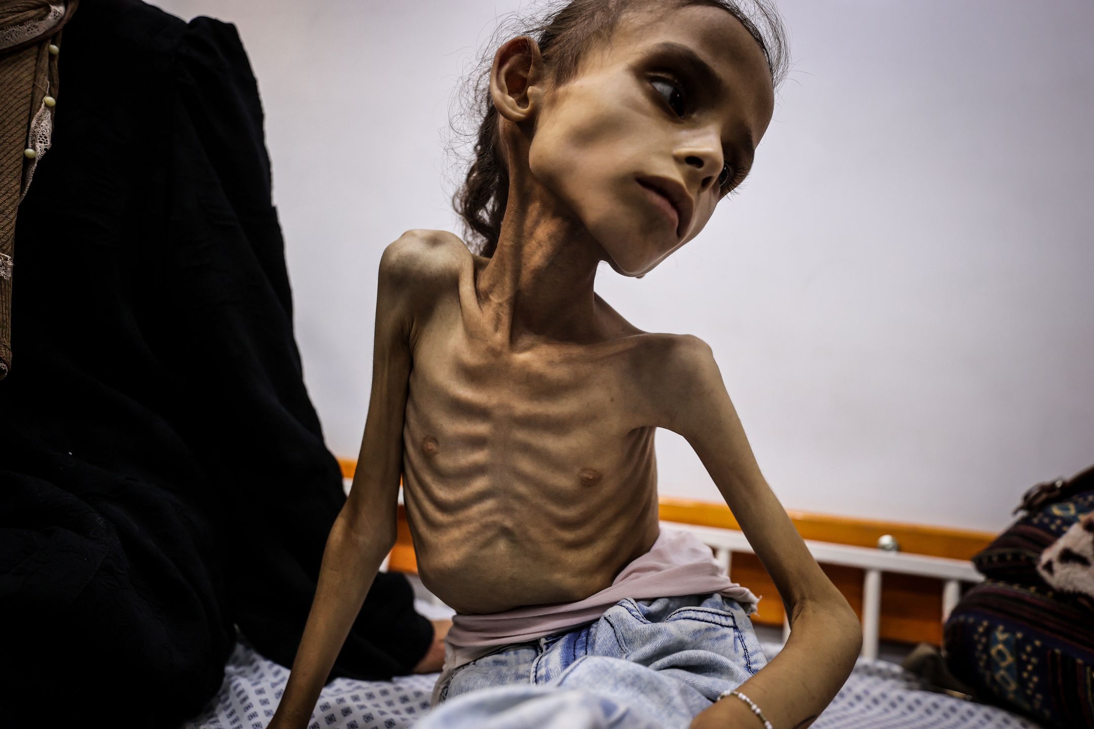 9-letnie dziecko z Gazy doświadcza zagrażającego życiu niedożywi