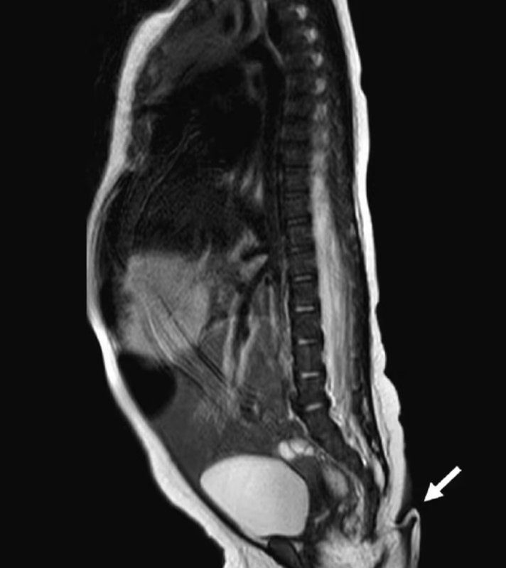 Dziewczynka urodziła się z 6-centymetrowym ogonem. 