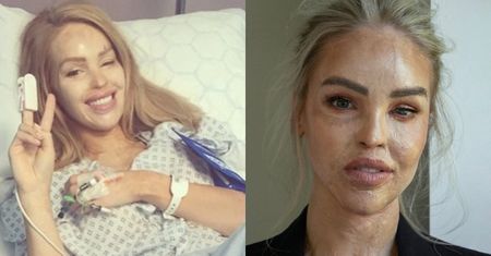 Katie Piper po oblaniu kwasem częściowo straciła wzrok. Przeszła ponad 400 ZABIEGÓW. Jak obecnie wygląda? (ZDJĘCIA)
