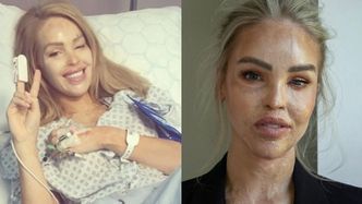 Katie Piper po oblaniu kwasem częściowo straciła wzrok. Przeszła ponad 400 ZABIEGÓW. Jak obecnie wygląda? (ZDJĘCIA)