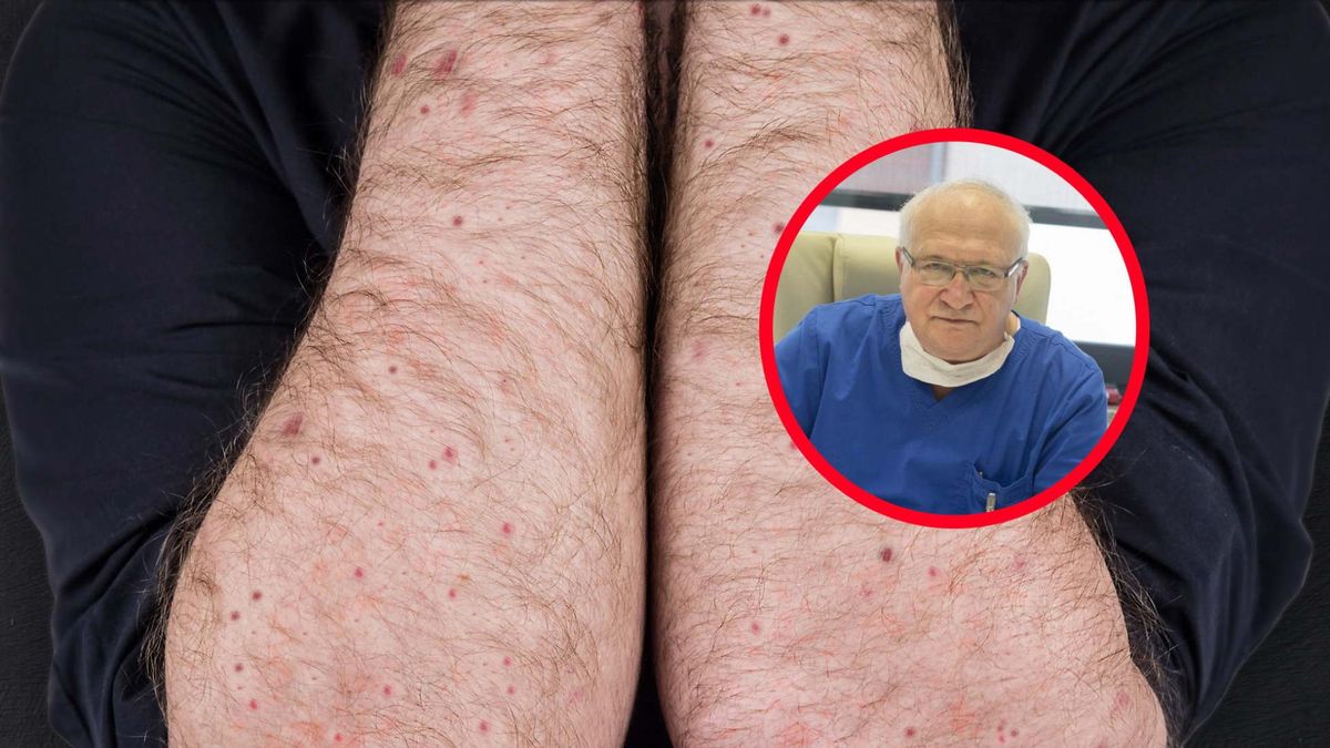 Lawina zachorowań. "To jest katastrofa, w klinice mam obecnie dziewiąty przypadek ciężkiej odry"