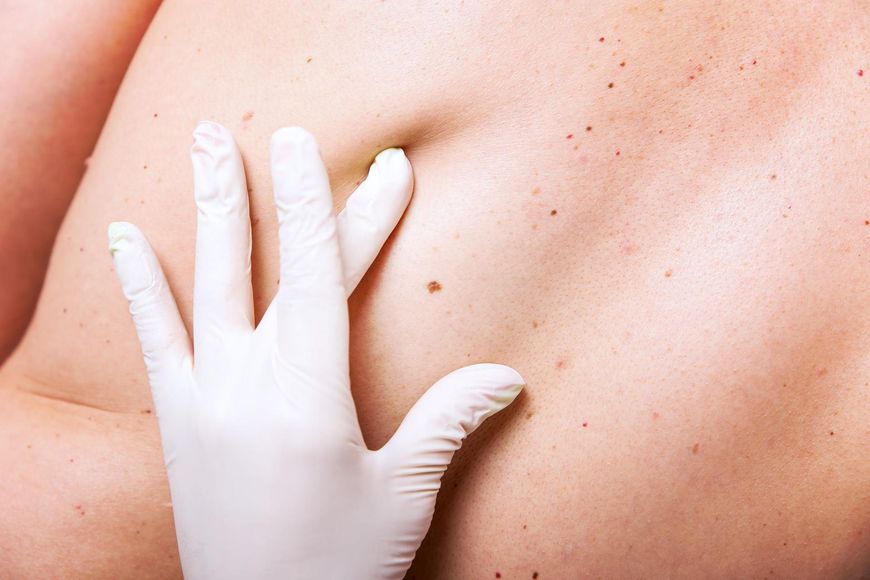 Rak skóry (bez czerniaka) - 4 tys. nowych zachorowań rocznie