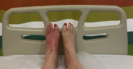 Margarita burn. Sok z limonki może wywoływać poważne poparzenia