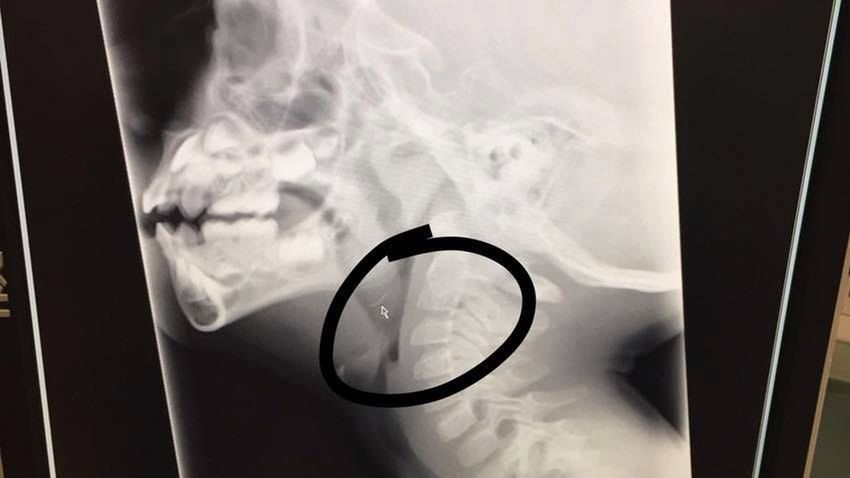 Wypadek na rodzinnym grillu. Chłopiec połknął kawałek metalowej szczotki 