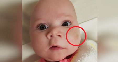 Zauważyła zmianę na policzku córki. Matka miała złe przeczucia