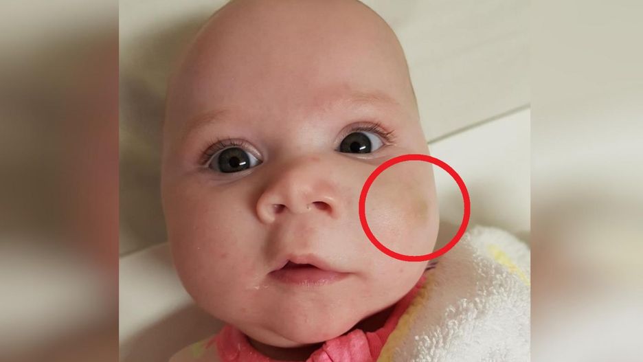 4-miesięczne niemowlę miało plamkę na policzku. Okazało się, że to rzadka choroba