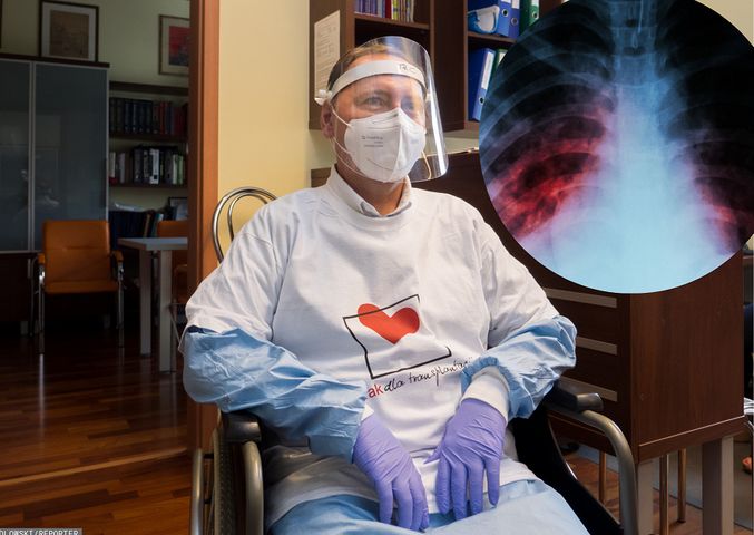 Pierwszy pacjent w Polsce, ktory przez COVID-19 musiał mieć przeszczepione płuca