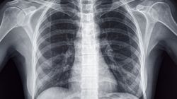 Złamanie mostka - objawy, diagnoza, leczenie