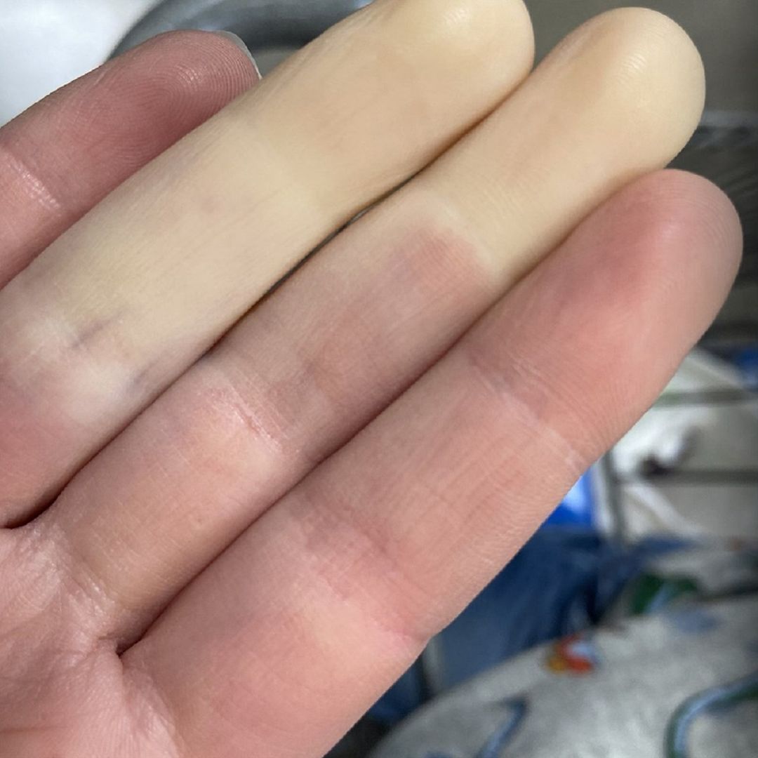 Objawy chorobyą Raynauda widać na dłoniach