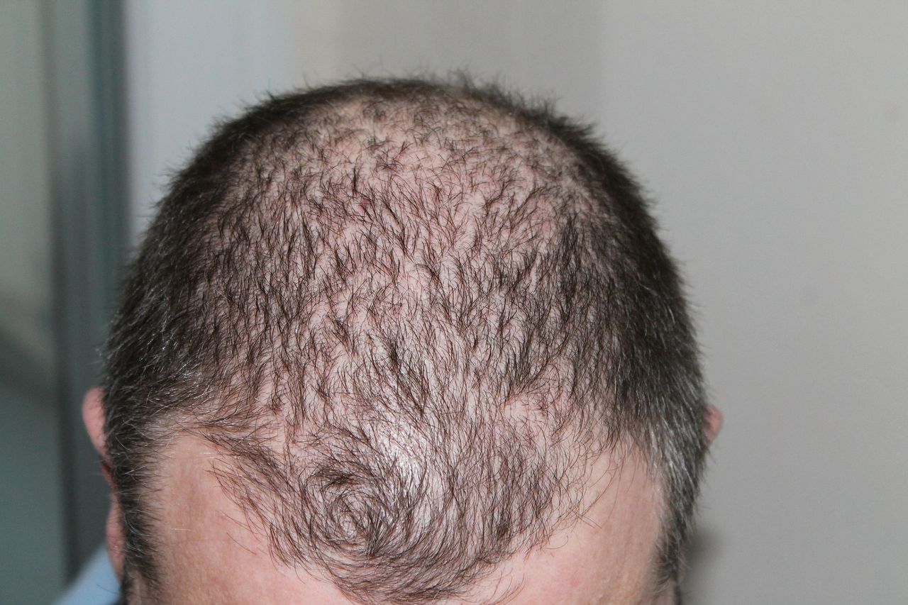 Naukowcy przyjrzeli się procesowi utraty włosów