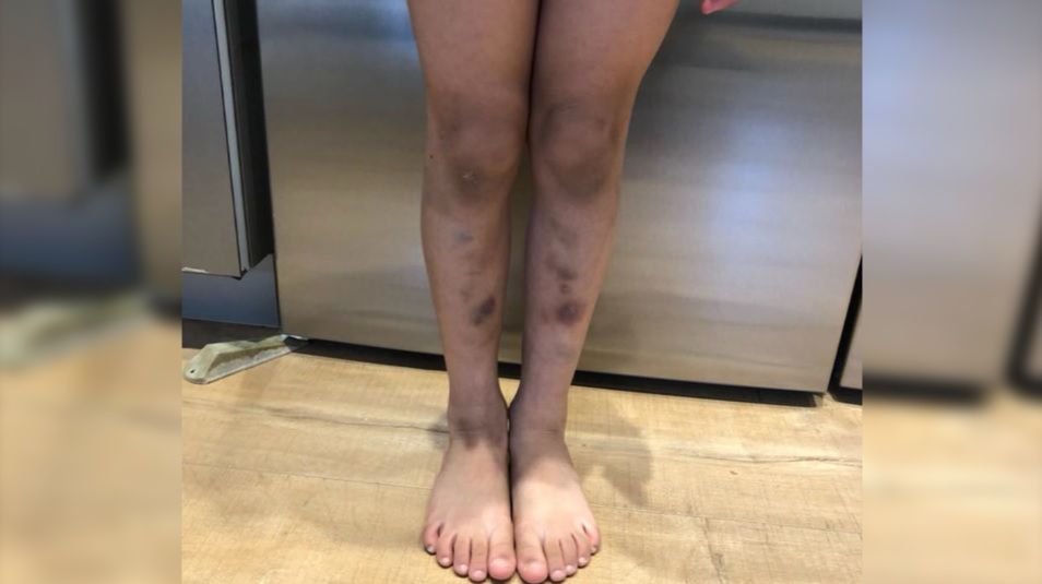 Dziewczynka miała siniaki na nogach. Okazały się objawem poważnej choroby (WIDEO)