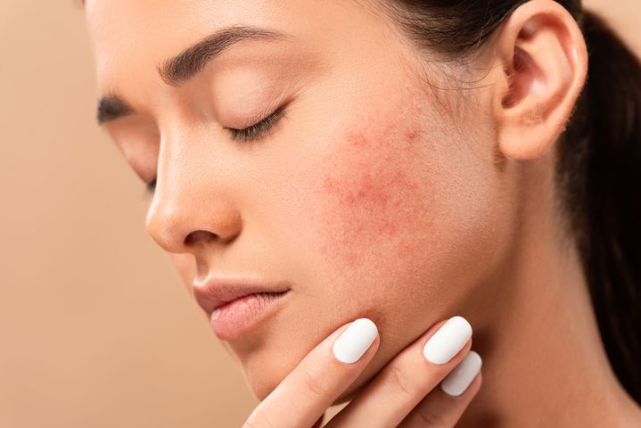 Ziarniniak kwasochłonny twarzy to przewlekła zapalna dermatoza