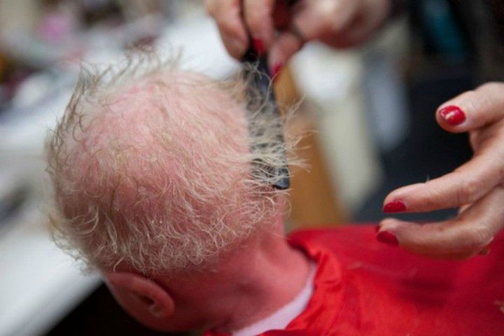 Brenna chora na rybią łuskę