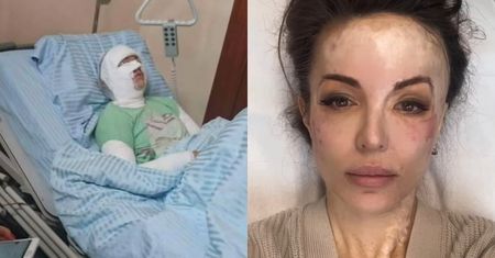 Kilka lat temu stalker oblał ją KWASEM. Tak dziś wygląda Katarzyna Dacyszyn