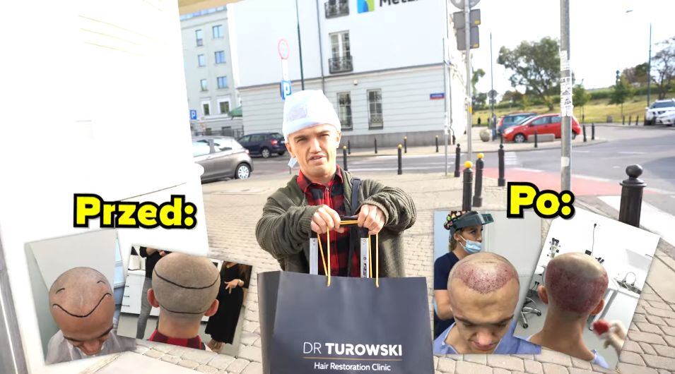 Mini Majk przeszczepił sobie włosy