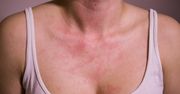 Pojawia się na szyi. Może znaczyć, że wątroba jest na wykończeniu
