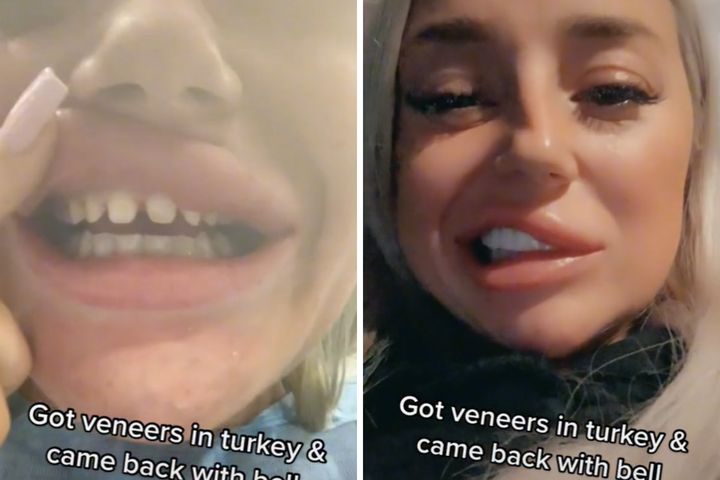 Pojechała do Turcji zrobić licówki. Wróciła ze sparaliżowaną twarzą