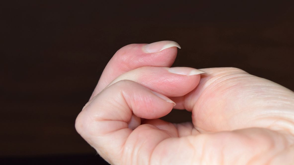 Charakterystycznie zakrzywione paznokcie mogą być objawem choroby