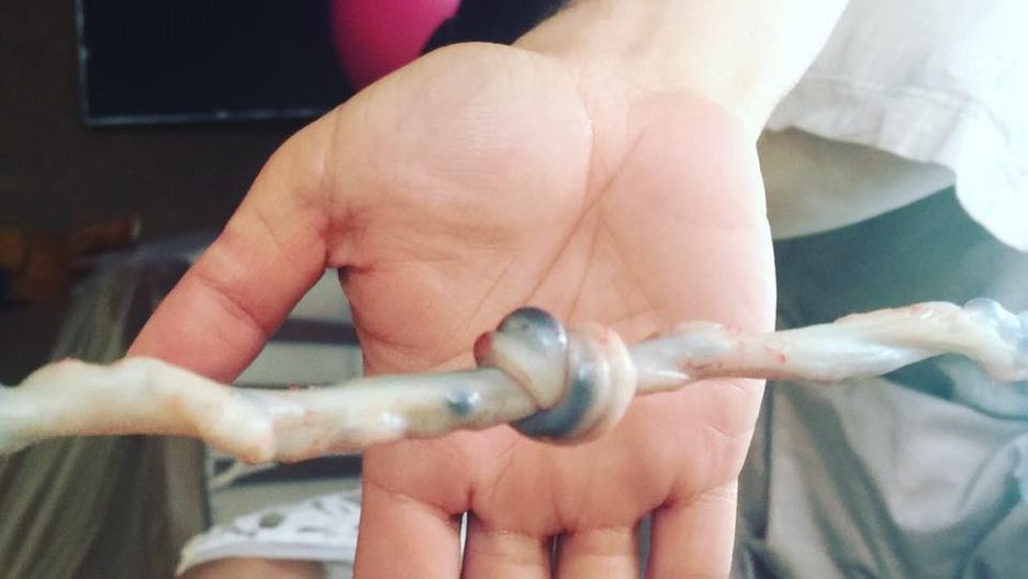 Węzeł na pępowinie. Lekarze zamarli, gdy to zobaczyli