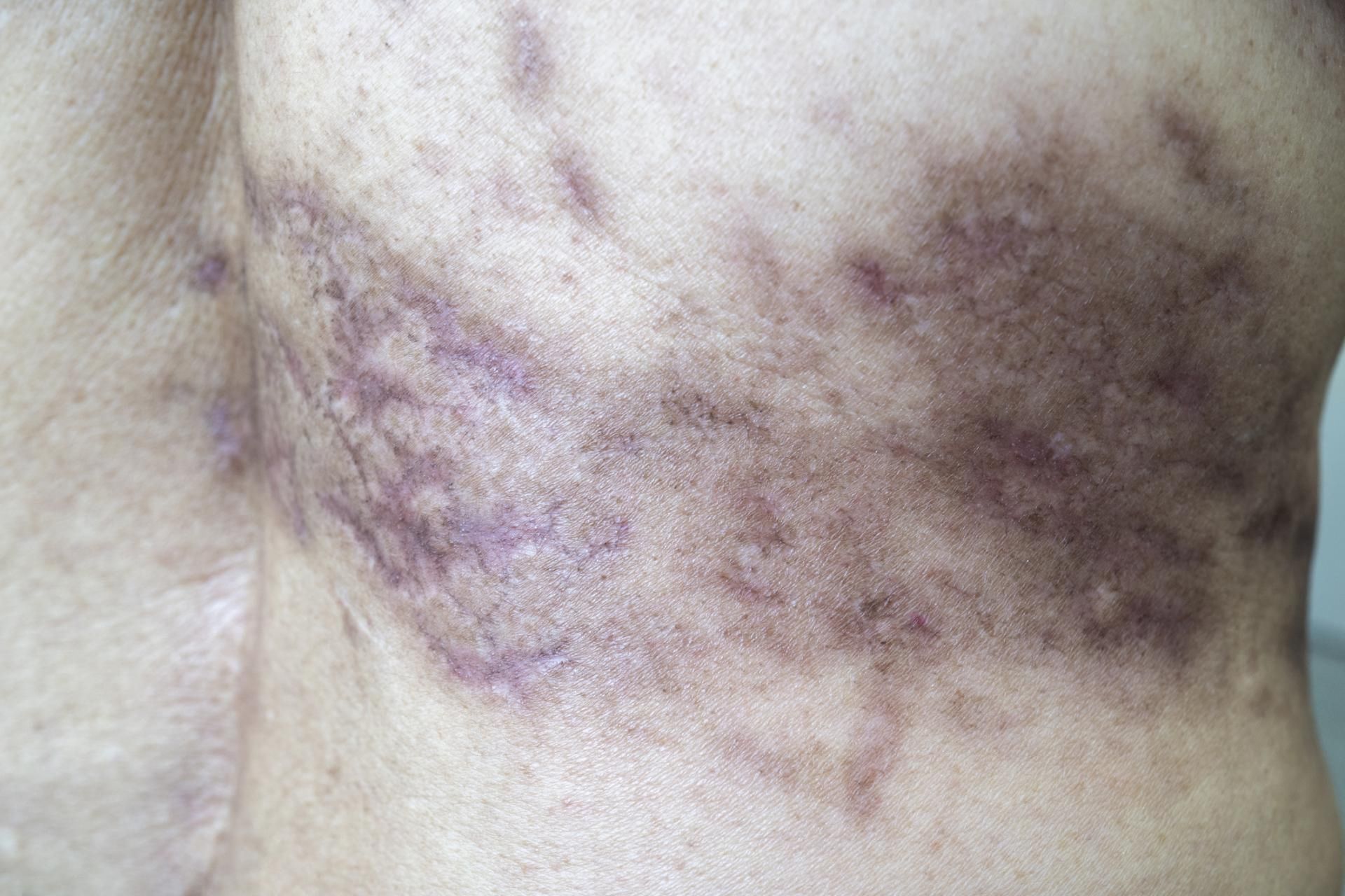 Różnego rodzaju zmiany skórne mogą ostrzegać o chorobach trzustki