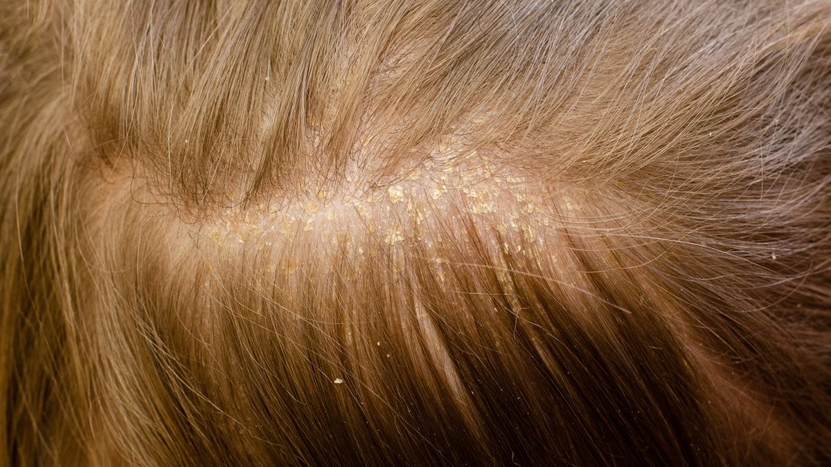 Łupież łojotokowy objawia się żółtawymi łatami złuszczającego się naskórka