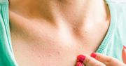Krostki na dekolcie – skąd się biorą i jak się ich pozbyć?