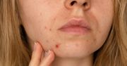 Lukrowanie skóry. Przebarwienia znikną w mig