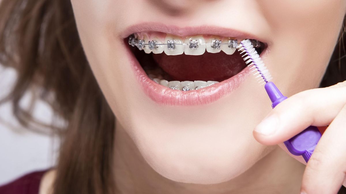 Aparat ortodontyczny wykorzystuje się do leczenia wad zgryzu oraz zaburzeń w ustawieniu zębów w łukach zębowych.