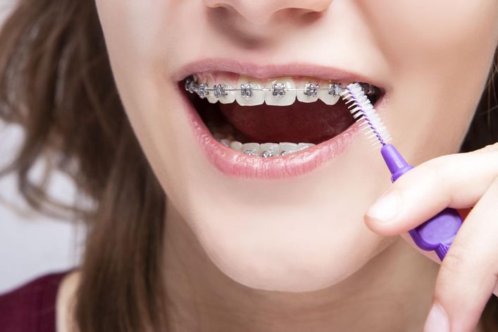 Aparat ortodontyczny wykorzystuje się do leczenia wad zgryzu oraz zaburzeń w ustawieniu zębów w łukach zębowych.
