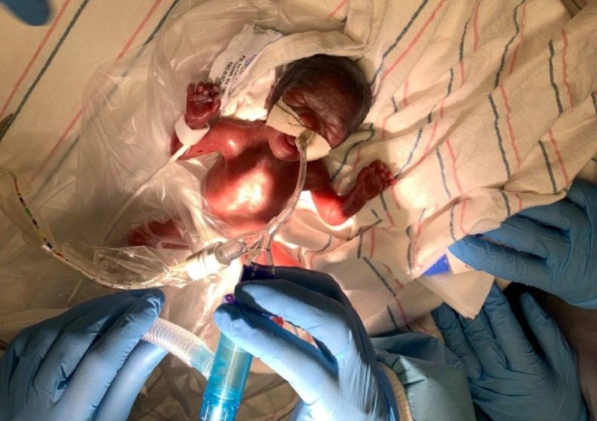 Bliźniaczki urodziły się po 22 tygodniach. Niezwykłe zdjęcie