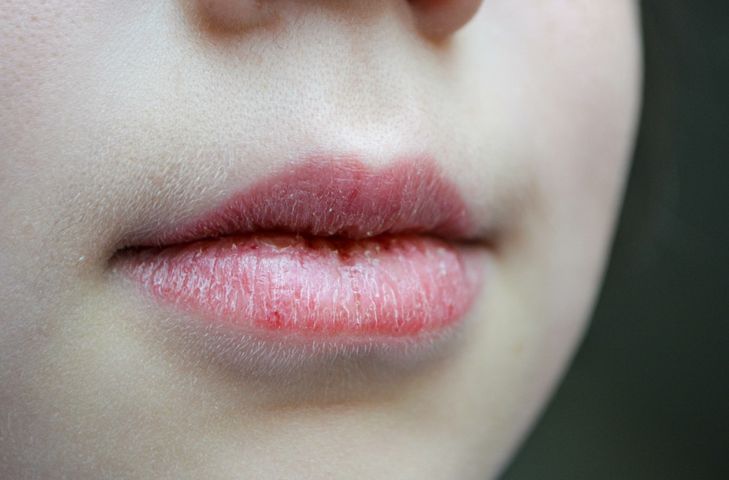 Zapalenie czerwieni wargowej to choroba ust, istotą której jest stan zapalny warg.