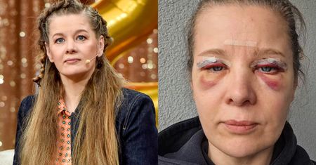 Anna Powierza wycięła nadmiar skóry na powiekach. Tak wygląda twarz aktorki po zabiegu (ZDJĘCIA)