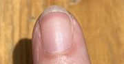 Pojawia się na paznokciach nawet u 80 proc. chorych. Znak, że wątroba wysiada