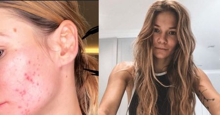 Maja Bohosiewicz chwali się, że pozbyła się trądziku. "Dam wam znać, jak się leczyłam"