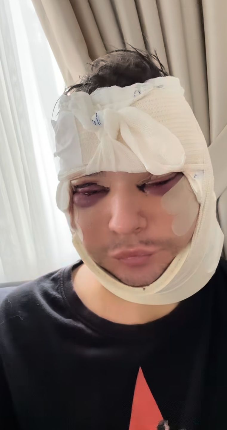 Drag queen Filo relacjonuje operację plastyczną w Turcji